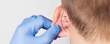 Klasik Kepçe Kulak Ameliyatı (Otoplasti)