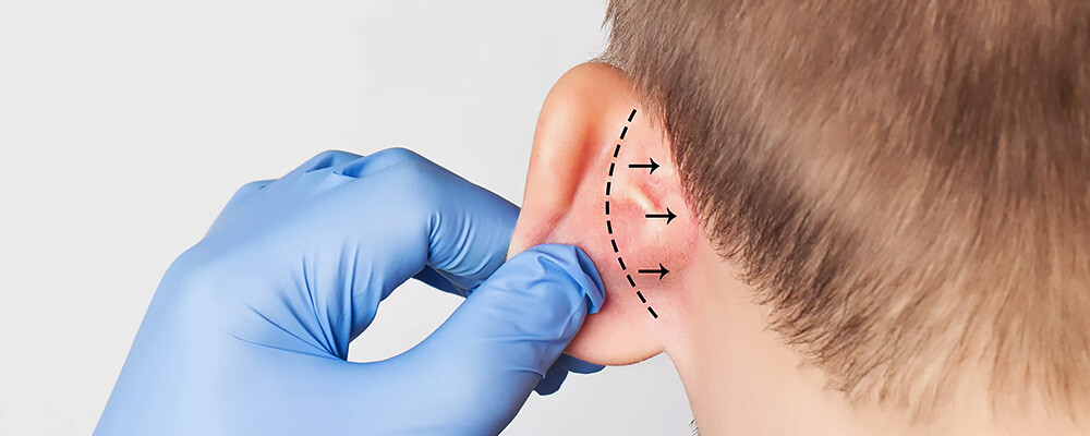 Klasik Kepçe Kulak Ameliyatı (Otoplasti)