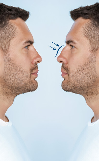 How long does it take to recover from nose surgery?
