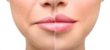 Lip Lift Ameliyatı