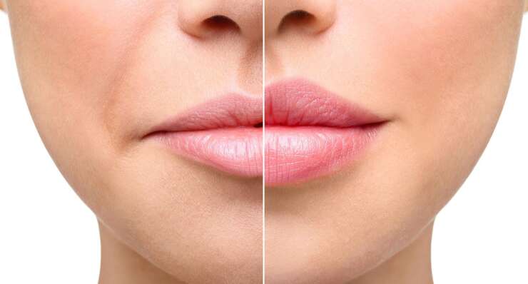 Lip Lift Ameliyatı