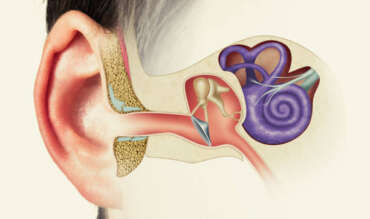 Ear Tube Insertion